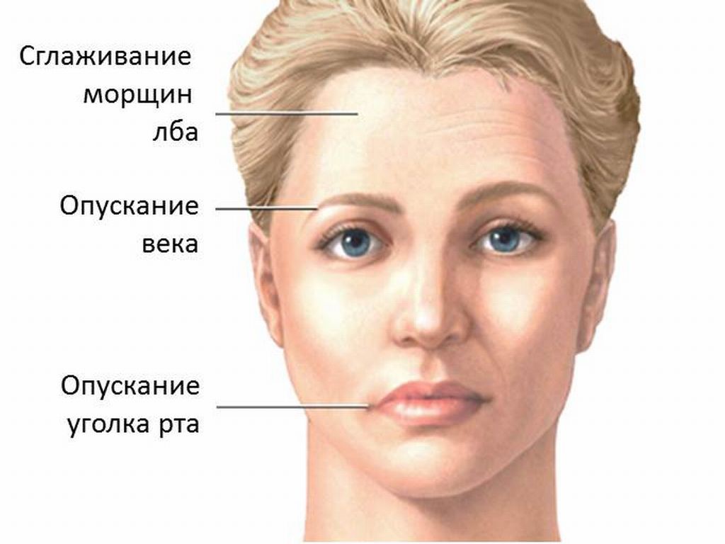 Невриты. Полиневриты. Полинейропатия