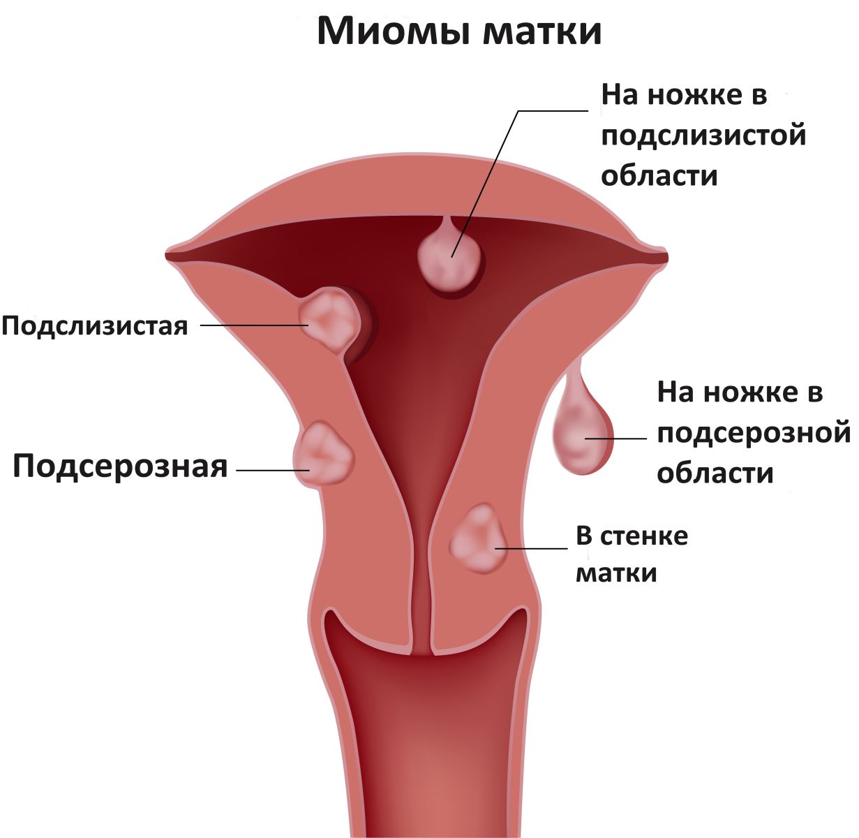 Миома